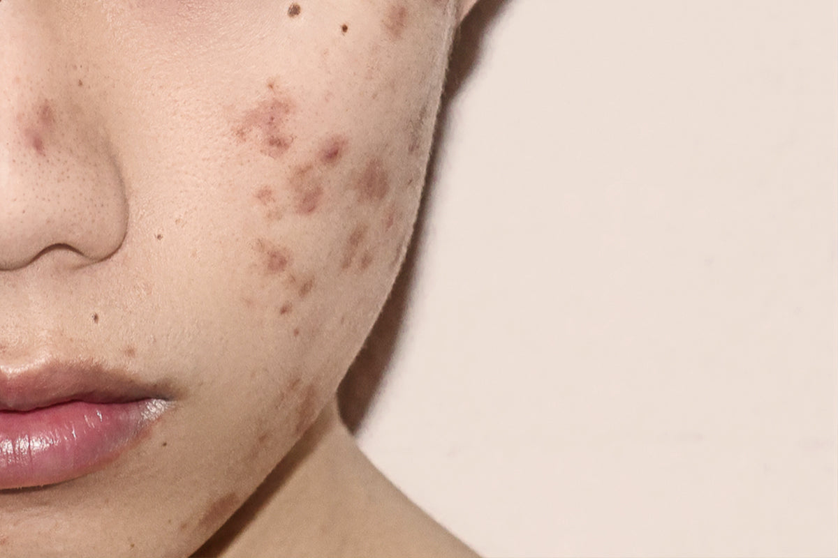 Adult Acne - What Causes It And How To Deal With It