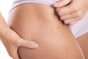 Stretch Marks – Can Anything Really Be Done About Them?